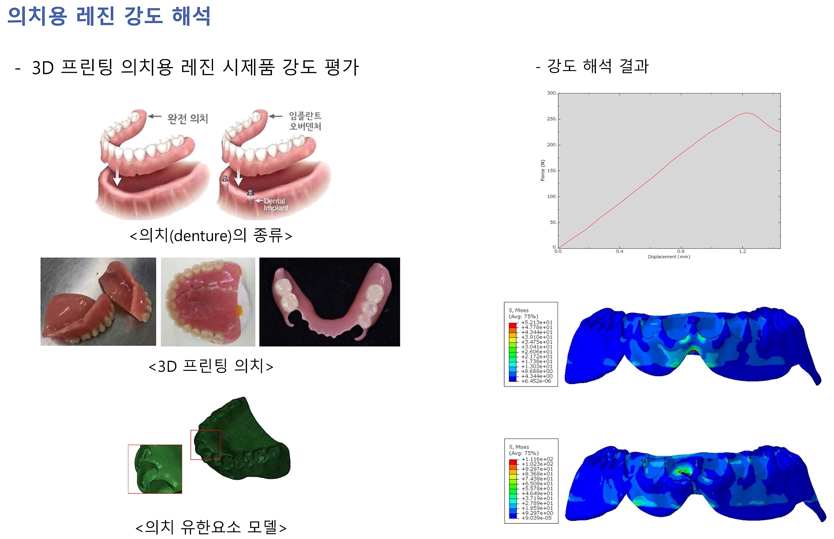 의치용 레진 강도 해석