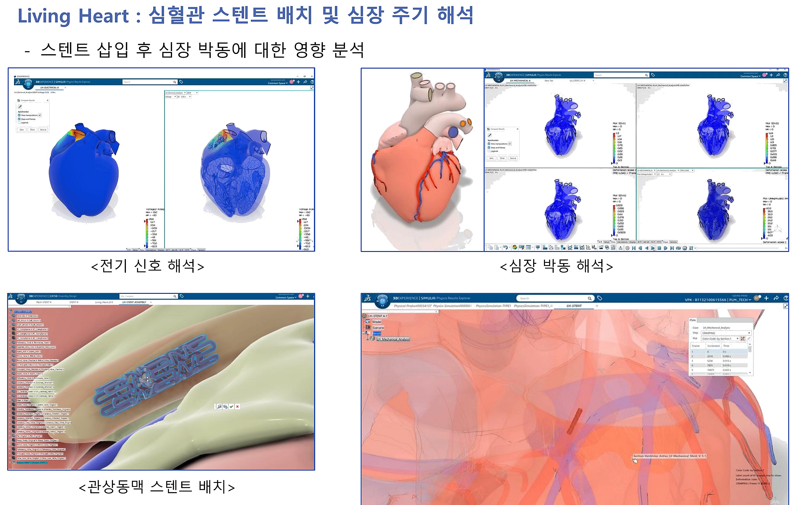 Living Heart 스텐트 해석